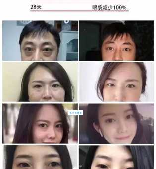 祛眼袋技术有哪些？不同方法效果大比拼！
