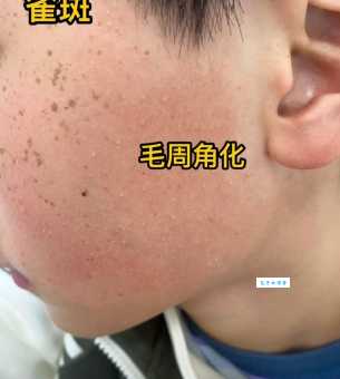 怎样治鸡皮肤？这5个小妙招你一定要知道！