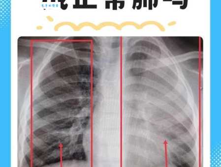 白肺是什么意思和肺炎有什么区别