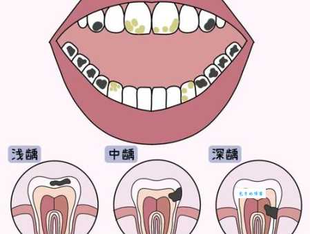 龋齿打一字你能猜到是哪个字吗