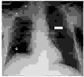 还在为“膈怎么读”纠结吗?答案就在这里超简单