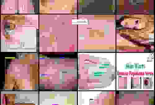 lichen是什么病症？皮肤上的lichen该怎么判断？